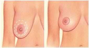 Breast lift surgery in India